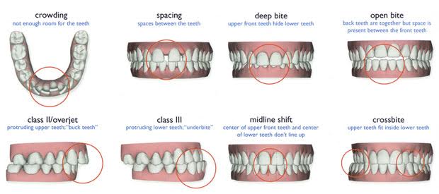 Overbite/Under-bite – Holmdel Dentist | Orthodontics | Braces | Invisalign