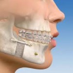 orthognathic jaw surgery
